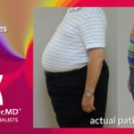 What are the causes of belly fat?