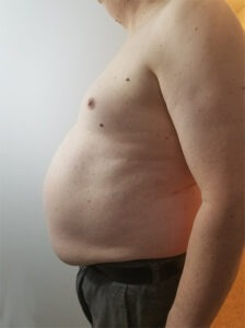 Obesity photo man