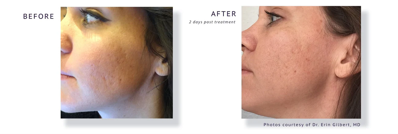 AQUAGOLD before and after results — skin texture and glow at CardioMender, MD