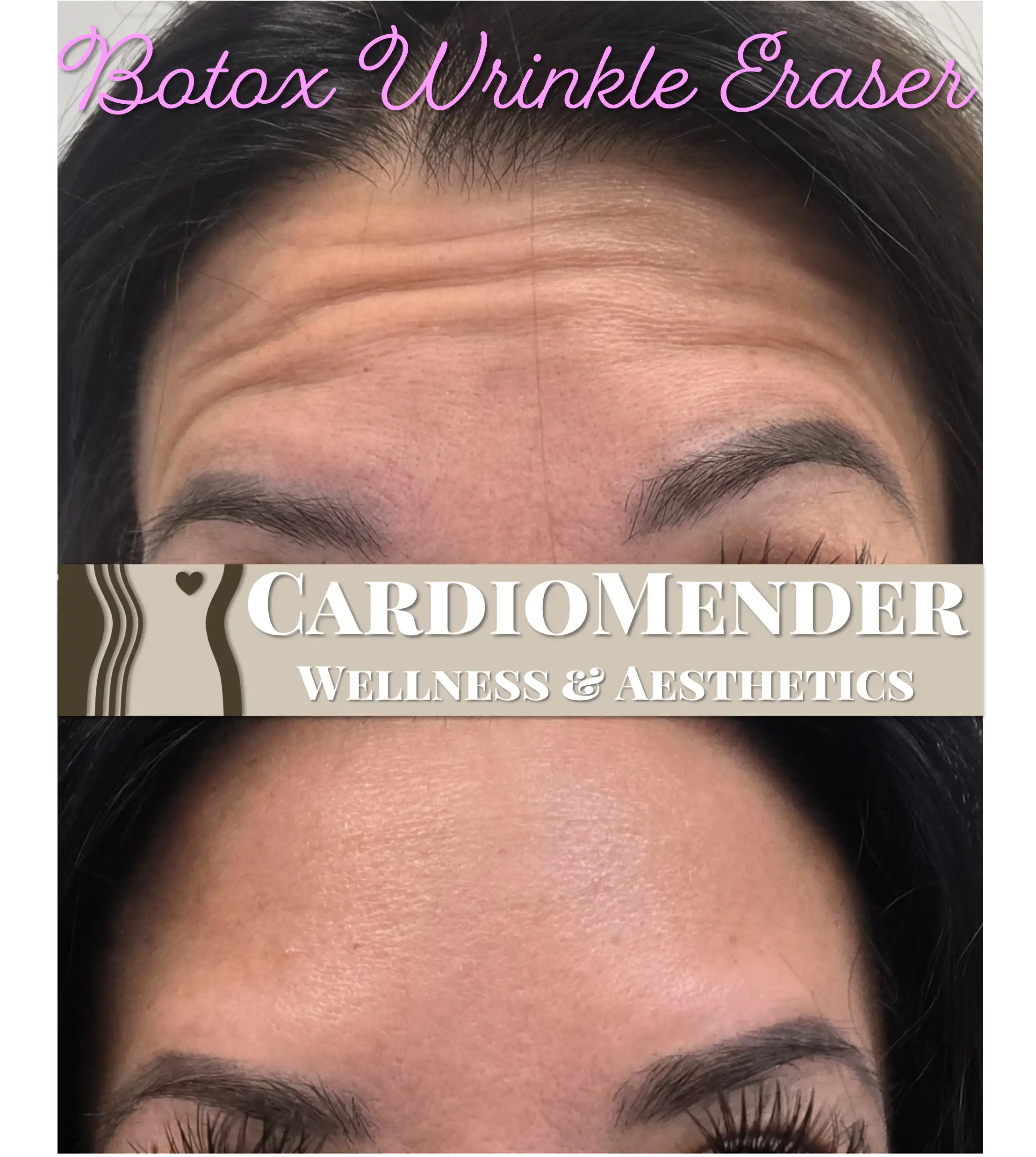 Botox treatment consultation at CardioMender, MD — smooth, natural results