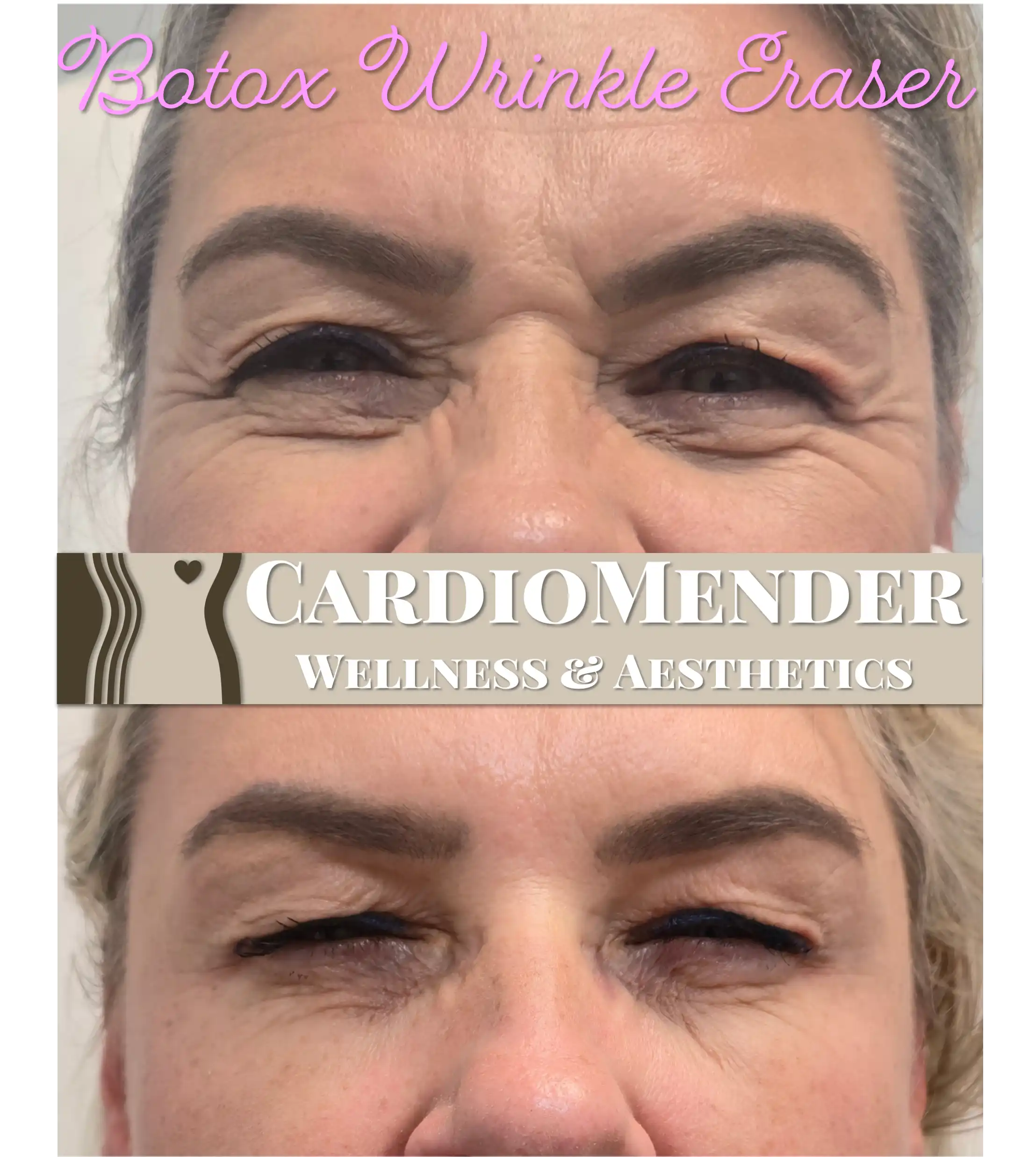 Botox results at CardioMender, MD — Pembroke Pines, FL