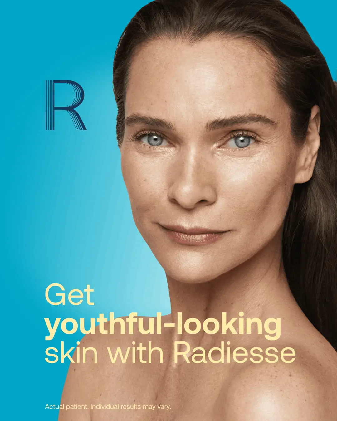 Radiesse treatment results — youthful-looking skin at CardioMender, MD