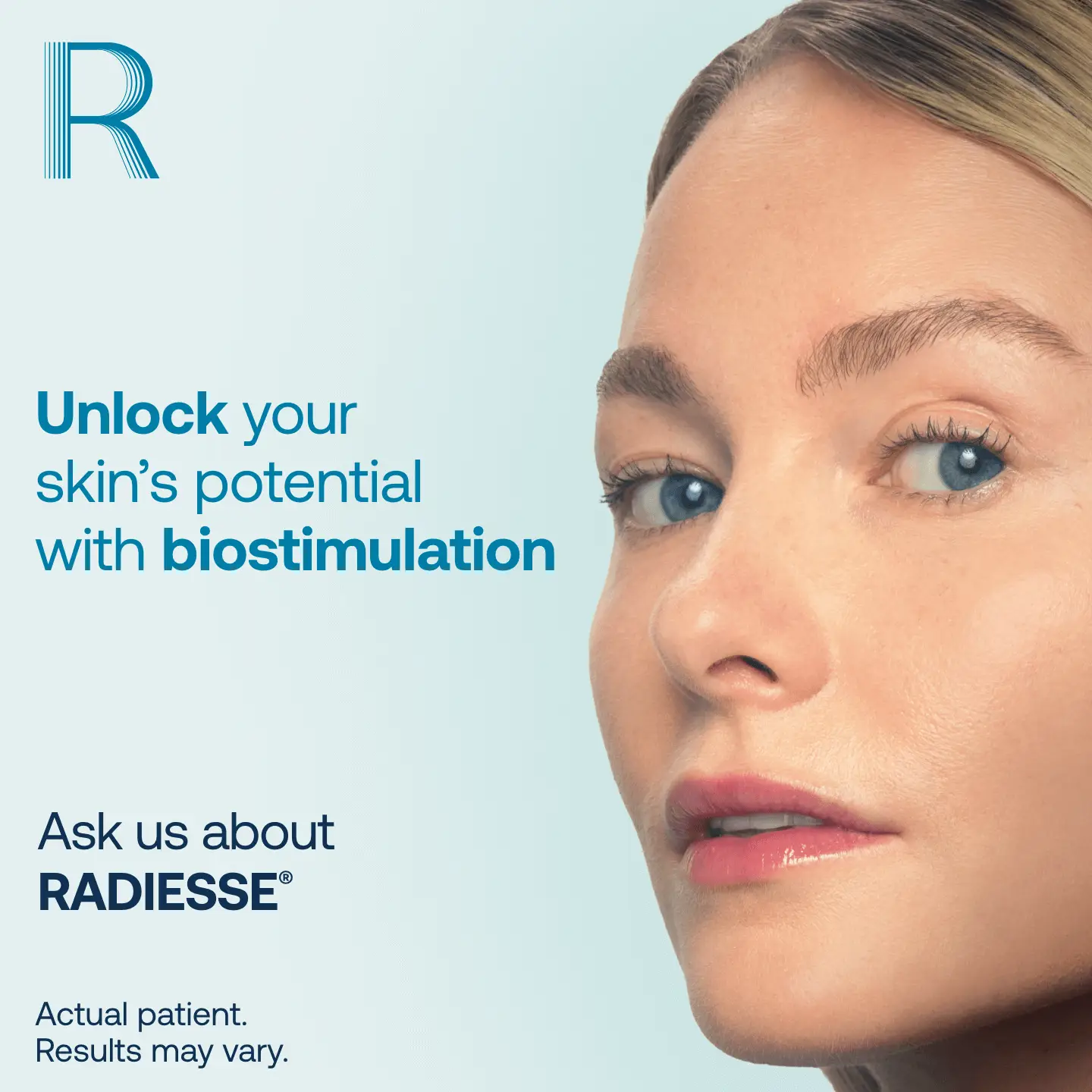Radiesse biostimulation treatment at CardioMender, MD — unlock your skin's potential